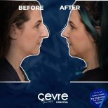 Vorher-nachher-Rhinoplastik-Ergebnisse bei Adem and Havva Medical Center, verbesserte Nasenform