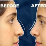 Vorher-nachher-Rhinoplastik-Ergebnis bei Adem and Havva Medical Center, verbesserte Nasenform