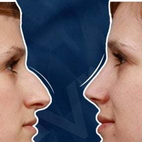 Vorher-nachher-Rhinoplastik-Ergebnisse bei Adem and Havva Medical Center, Nasenkorrektur
