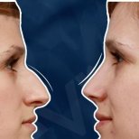 Vorher-nachher-Rhinoplastik-Ergebnisse bei Adem and Havva Medical Center, Nasenkorrektur