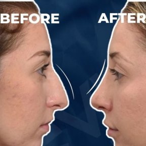 Vorher-nachher-Rhinoplastik-Ergebnisse bei Adem and Havva Medical Center, Nasenkorrektur