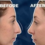 Vorher-nachher-Rhinoplastik-Ergebnisse bei Adem and Havva Medical Center, Nasenkorrektur