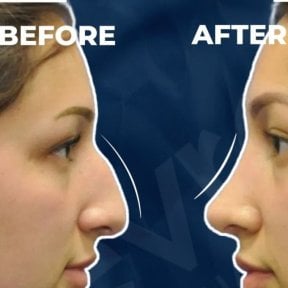 Vorher-nachher-Rhinoplastik-Ergebnisse bei Adem and Havva Medical Center, verbesserte Nasenform