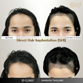 Before and after DHI hair transplant results at ID Clinic Bangkok, improved hairline in 14 days