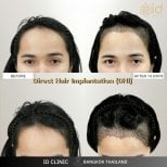 Before and after DHI hair transplant results at ID Clinic Bangkok, improved hairline in 14 days