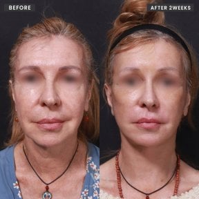 Résultats avant/après mini lifting chez VG Plastic Surgery – rajeunissement du visage