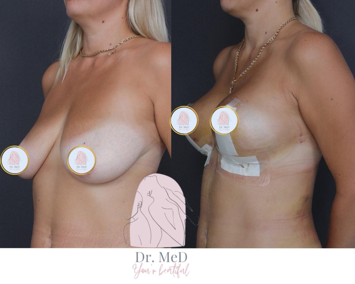 نتائج تصغير الثدي قبل وبعد في عيادة Dr. MED – تحسين شكل ورفع الثدي