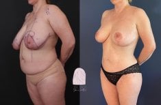 Before and after breast reduction results at Dr. MED – improved breast shape and contour