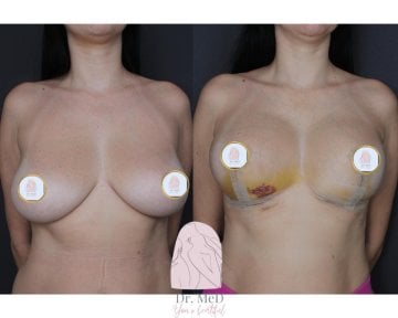 Before and after breast reduction results at Dr. MED clinic, improved breast contour visible