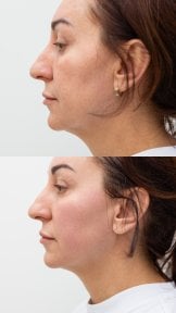 Résultats avant/après lifting du visage à Altos Clinic – amélioration du contour facial
