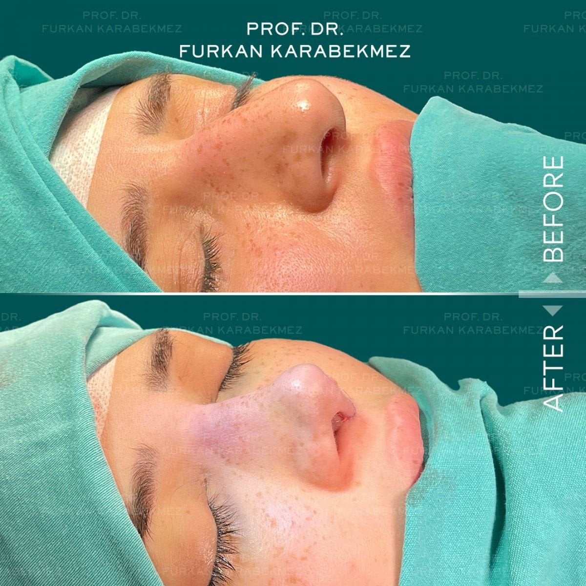 Resultados de rinoplastia antes y después en la Clínica Estética Prof. Furkan Karabekmez