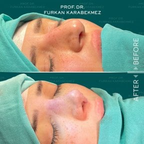 Vorher-nachher-Ergebnisse der Nasenkorrektur in Prof. Karabekmez' Klinik für Ästhetische Chirurgie