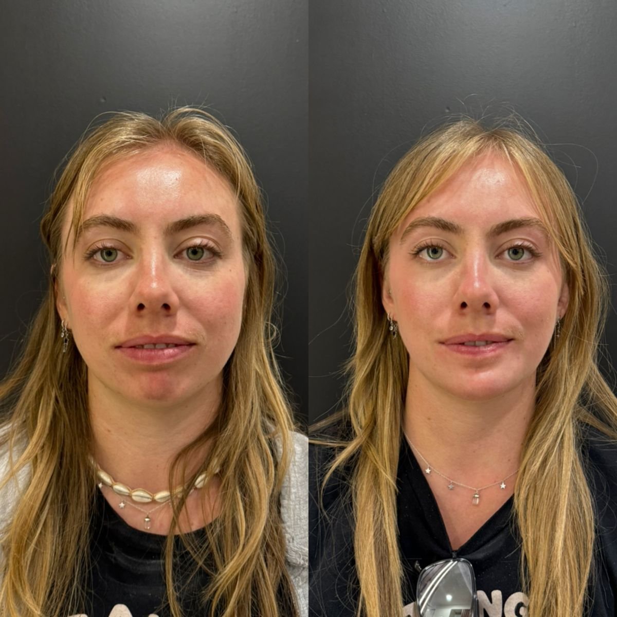 Before and after buccal fat extraction results at Dr. Alexandro Aguilera - Plastic Surgery clinic