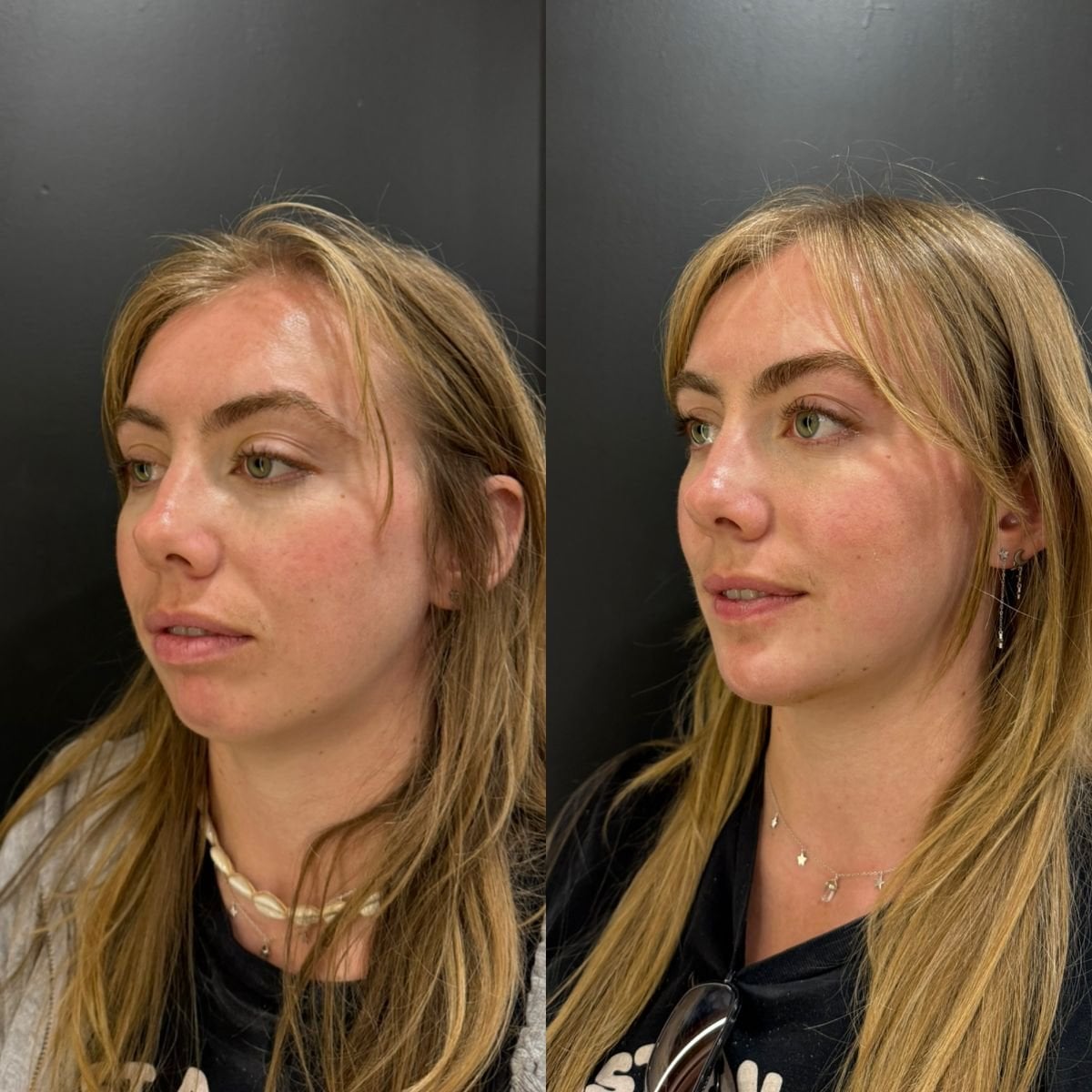 Resultado antes y después de extracción de bolas de Bichat en Dr. Alexandro Aguilera