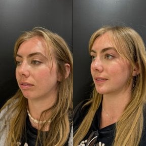 Результат до и после удаления комков Биша в клинике Dr. Alexandro Aguilera - Plastic Surgery