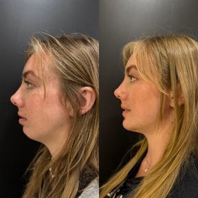 Результат до и после удаления комков Биша в клинике Dr. Alexandro Aguilera - Plastic Surgery