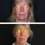 نتائج شد الوجه قبل وبعد في Esthétique du Nord – تجديد واضح لملامح الوجه