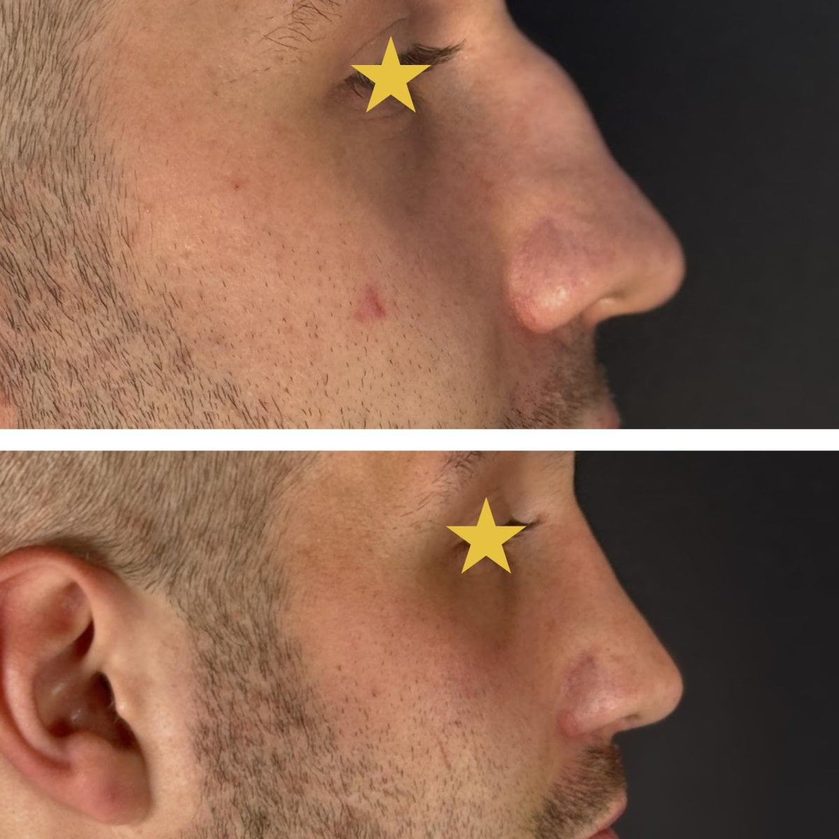 Resultados antes y después de rinoplastia secundaria en Esthétique du Nord, perfil nasal mejorado