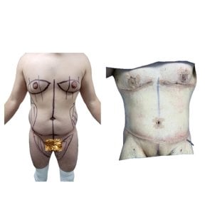 Before and after tummy tuck and liposuction results at Hospital de la Familia, male patient
