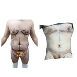 Before and after tummy tuck and liposuction results at Hospital de la Familia, male patient