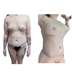 Before and after tummy tuck and liposuction results at Hospital de la Familia, body contouring