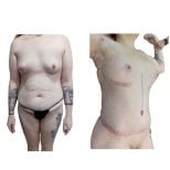 Before and after tummy tuck and liposuction results at Hospital de la Familia, body contouring