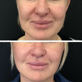 نتائج شد الوجه قبل وبعد في Esthétique du Nord – تجديد واضح للوجه