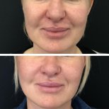 نتائج شد الوجه قبل وبعد في Esthétique du Nord – تجديد واضح للوجه