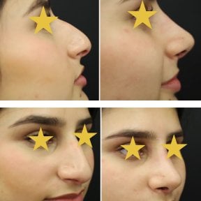 Vorher-nachher-Ergebnisse der Nasenkorrektur bei Esthétique du Nord, natürliches Ergebnis