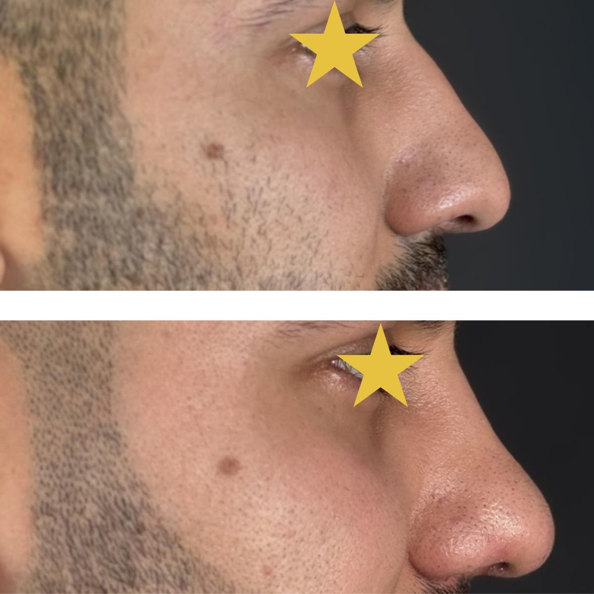 نتائج عملية تجميل الأنف قبل وبعد في Esthétique du Nord، تحسين شكل الأنف للرجال