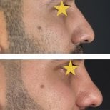 Результати ринопластики до і після в Esthétique du Nord, покращений профіль носа у чоловіків