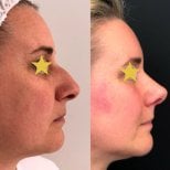 Vorher-nachher-Rhinoplastik bei Esthétique du Nord, verbesserte Nasenform und Profil