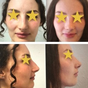 Vorher-nachher-Ergebnisse der Nasenkorrektur bei Esthétique du Nord, natürliches Ergebnis