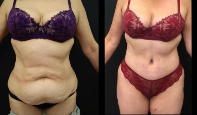 Vorher-nachher-Ergebnis Bauchdeckenstraffung bei Esthétique du Nord – verbesserte Bauchkontur