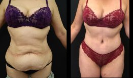 Vorher-nachher-Ergebnis Bauchdeckenstraffung bei Esthétique du Nord – verbesserte Bauchkontur