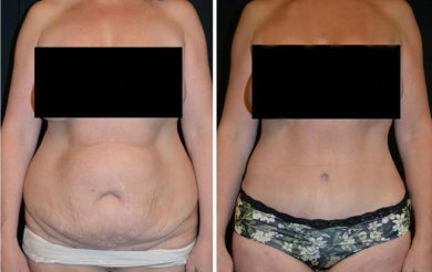 Vorher-nachher-Ergebnis Bauchdeckenstraffung bei Esthétique du Nord – verbesserte Silhouette