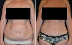Vorher-nachher-Ergebnis Bauchdeckenstraffung bei Esthétique du Nord – verbesserte Silhouette