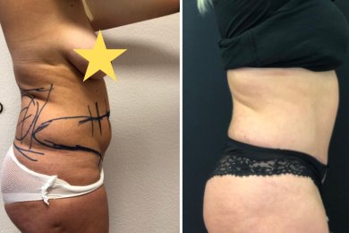 Vorher-nachher-Ergebnisse der Bauchdeckenstraffung bei Esthétique du Nord – sichtbare Konturverbesserung
