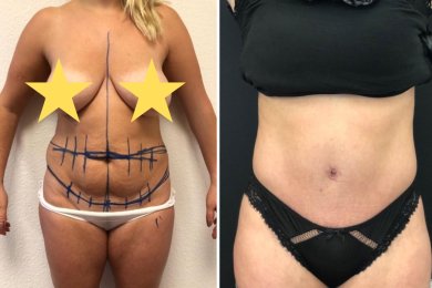 Vorher-nachher-Ergebnis Bauchdeckenstraffung bei Esthétique du Nord, verbesserte Bauchkontur