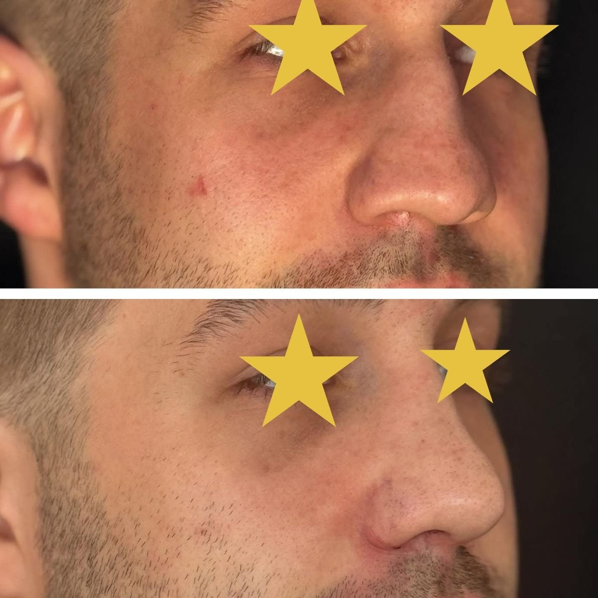 Resultados antes y después de rinoplastia secundaria en Esthétique du Nord, contorno mejorado