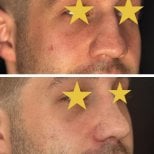 Результати до та після ревізійної ринопластики в Esthétique du Nord, покращена форма носа