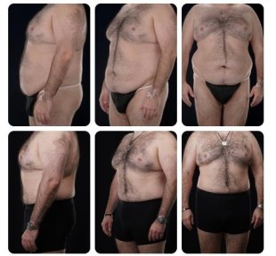 Before and after tummy tuck results for men at Yurchenko Plastic Surgery Team, flatter abdomen