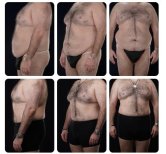 Before and after tummy tuck results for men at Yurchenko Plastic Surgery Team, flatter abdomen