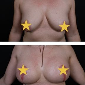 نتائج شد الثدي قبل وبعد في Esthétique du Nord – تحسين شكل ورفع الثدي