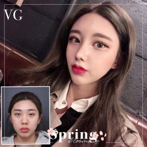 Asian rhinoplasty before and after results at VG Plastic Surgery – refined nose shape outcome