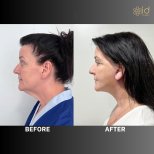 Before and after deep plane facelift results at ID Clinic Bangkok, visible facial rejuvenation