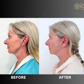 Before and after deep plane facelift results at ID Clinic Bangkok, visible facial rejuvenation