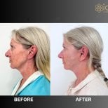 Facelift before and after results at ID Clinic Bangkok, visible facial rejuvenation and contouring