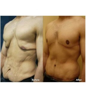 Before and after tummy tuck results for men at ID Clinic Bangkok, improved abdominal contour