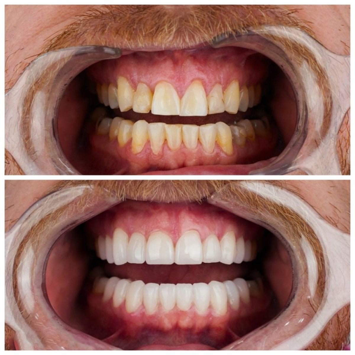 نتائج قبل وبعد ابتسامة هوليوود في Nifa Dent International – أسنان بيضاء ومتساوية